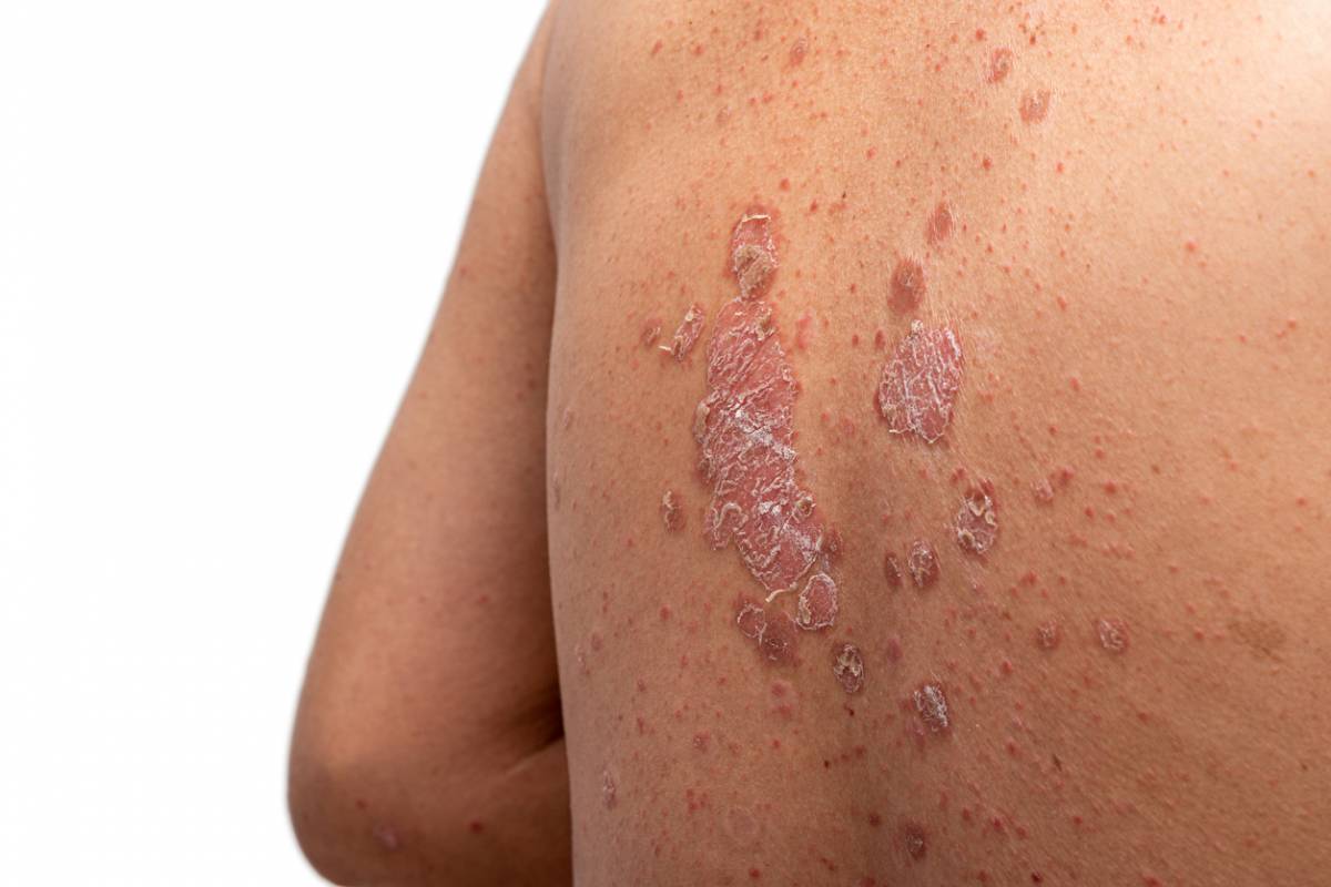 Soigner le psoriasis : pourquoi privilégier un traitement naturel ?